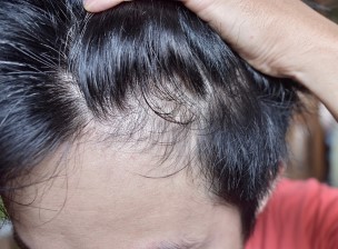 Thinning,Or,Sparse,Hair,,Male,Pattern,Hair,Loss,And,Bald